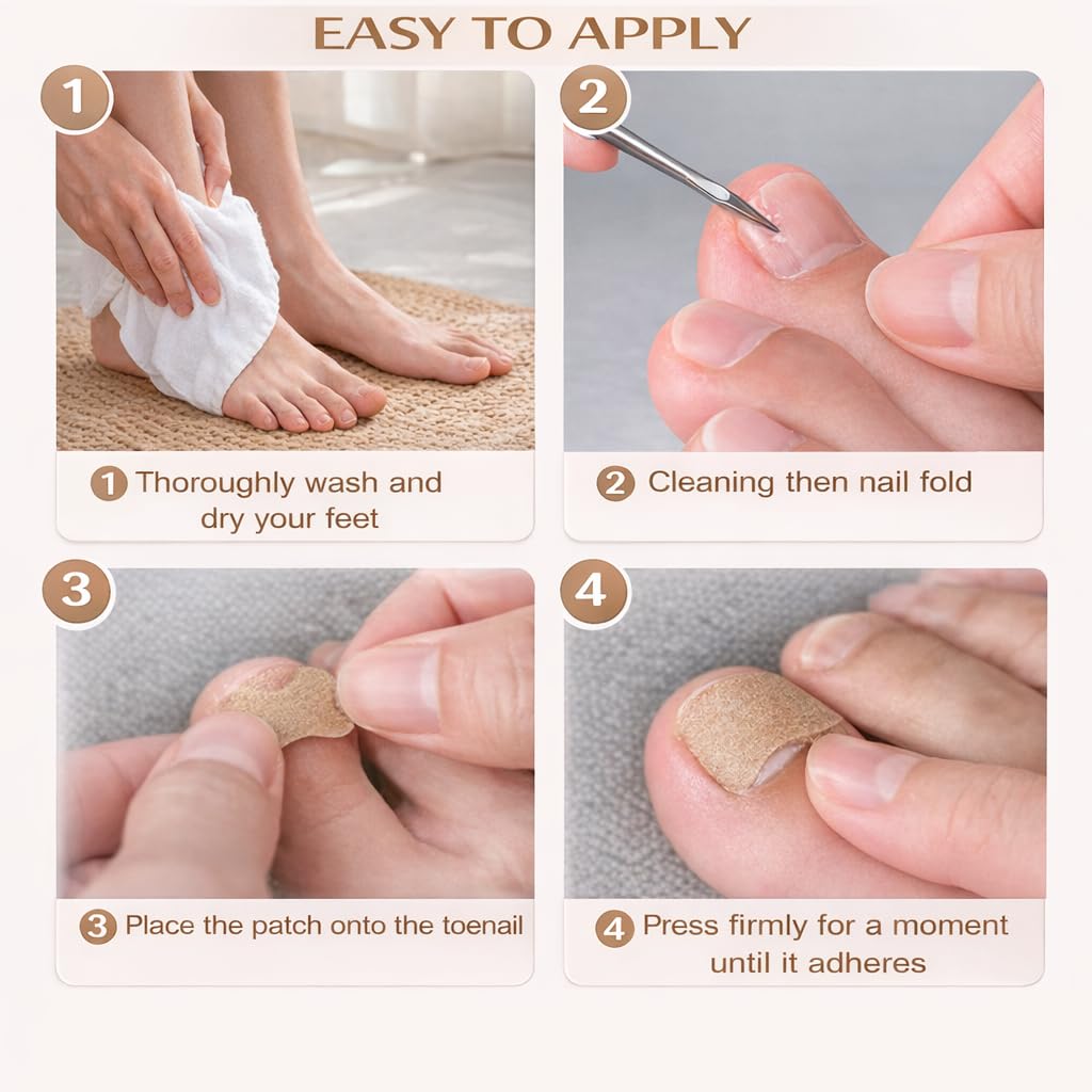 Ingrown Toenail Corrector & Toenail Correction Kit with Soft Breathable Strips, Stainless Steel Tools and Elastic Fiber Toe Sleeves; Ideal for Runners, Long-Hour Workers and Tight-Shoe Wearers
