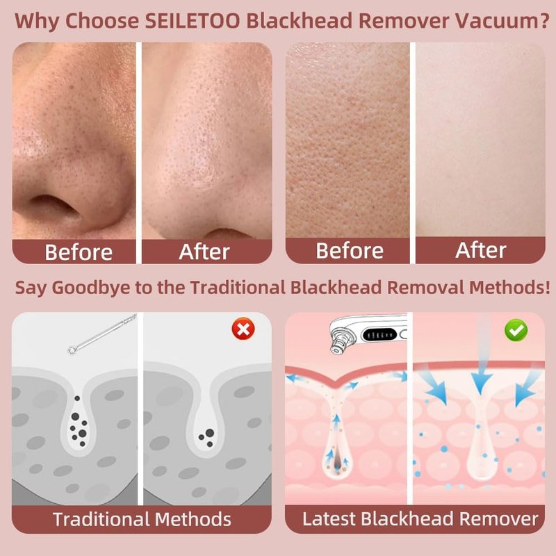 Blackhead Remover Vacuum - 5-Speed Type-C Rechargeable Extractor with 4 Heads | Effective Face & Nose Tool for All Skin Types