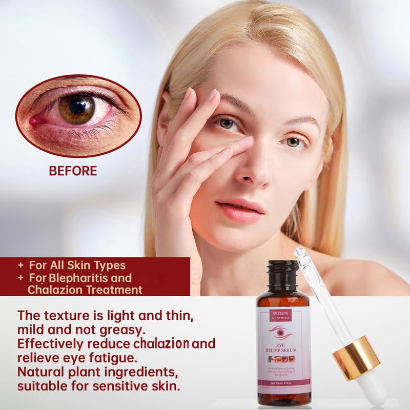 MIZEEYE 2PCS Eye Relief Serum for Blepharitis & Chalazion, Moisturizing Under Eye Care