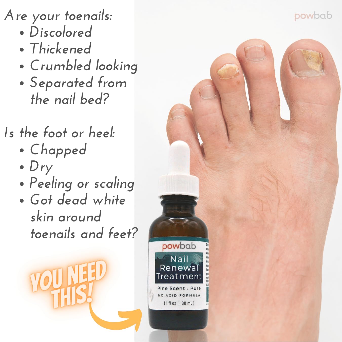 powbab Nail Renewal Treatment for Toenail. Pine Needle Scent, No Acid Formula. 100% Natural Solution Toenail Treatment Extra Strength for Foot and Nail. Natural Toe Nail Treatment - 1 oz