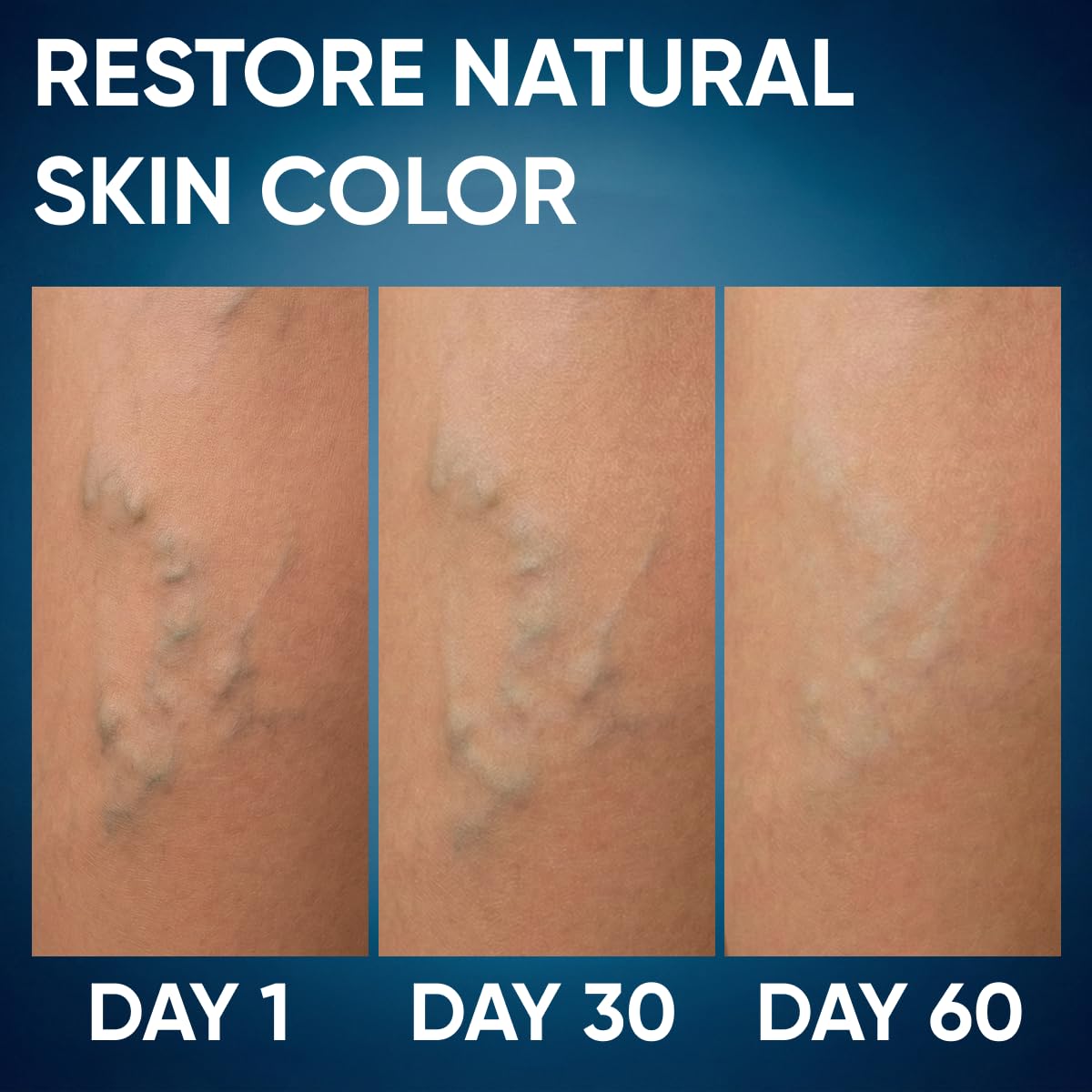 PENIKOSETE Varicose & Spider Vein Cream for Legs, 3 Month Supply 6.76 oz Jar | Dermatologically Tested Ayurvedic Ashwagandha Formula | Non-Sticky for Tired, Swollen & Heavy-Looking Legs | Men & Women