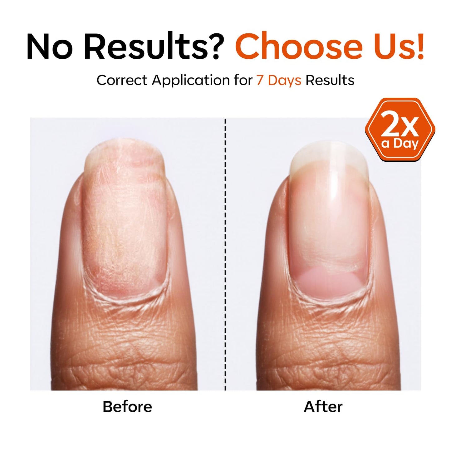 Nail Strengthener & Growth - Extra Strong 3-in-1 Clear Hardener for Damaged Nails | 13.5ml
