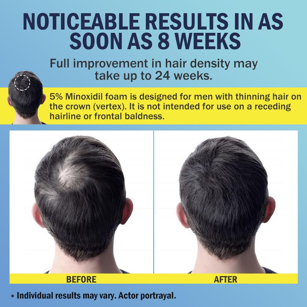 Ruahouine 5% Minoxidil Foam for Hair Regrowth, Topical Hair Loss Treatment for Men to Regrow Fuller, Thicker Hair, Rosemary Minoxidil Topical Aerosol, 60ml / 2.11oz
