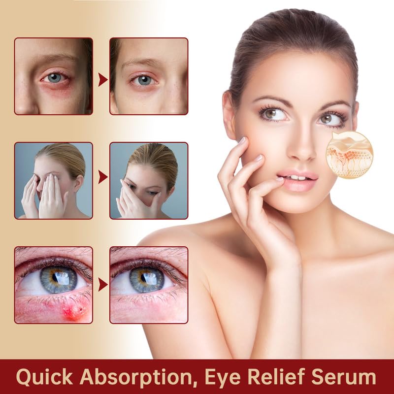 MIZEEYE 2PCS Eye Relief Serum for Blepharitis & Chalazion, Moisturizing Under Eye Care