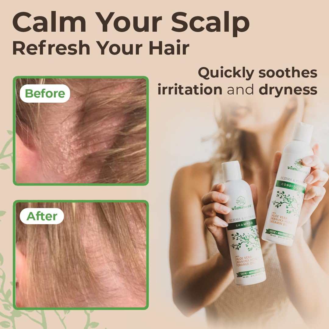 Eczema Psoriasis Shampoo & Conditioner Set | Anti-Dandruff Treatment for Dry Scalp & Itchy Hair