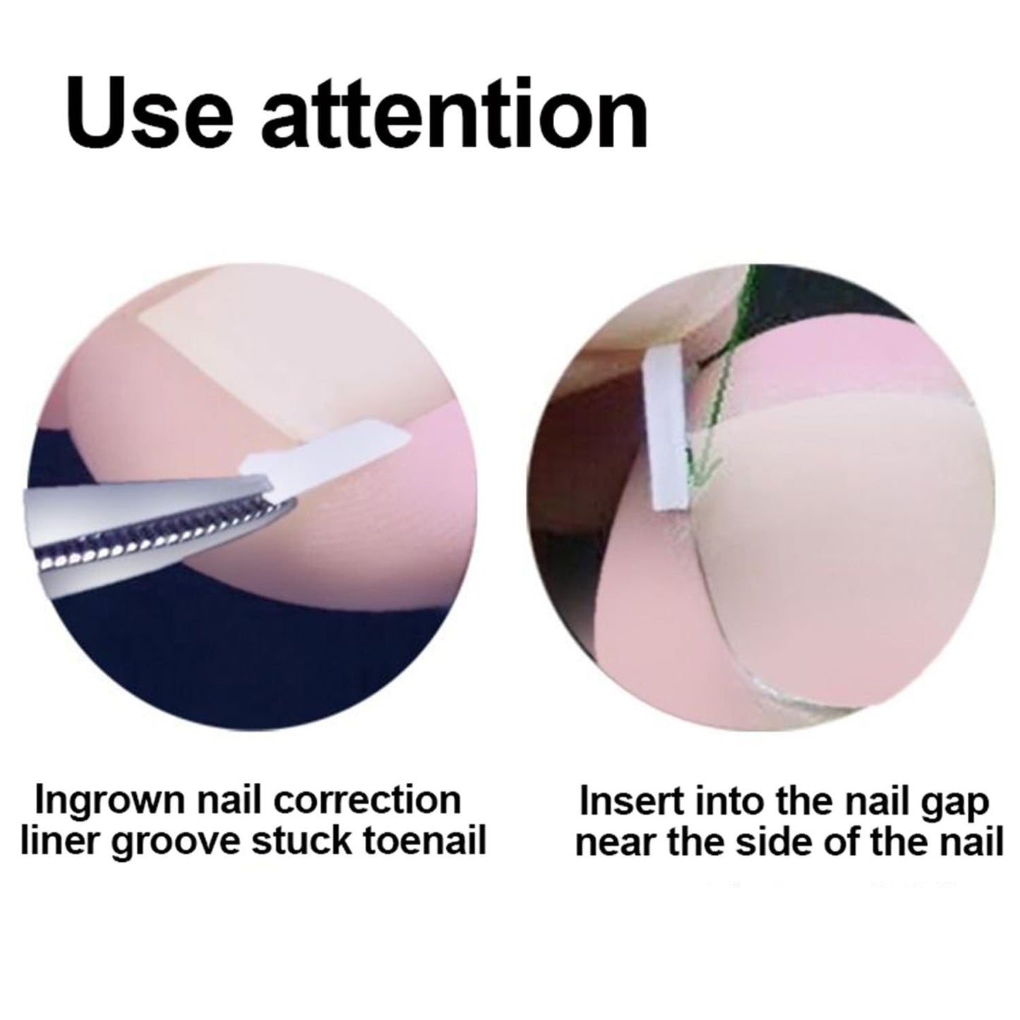 Ingrown Toenail Toolkit - Painless Curved Toenail Corrector with Breathable Strips & File | Home Pedicure Essential