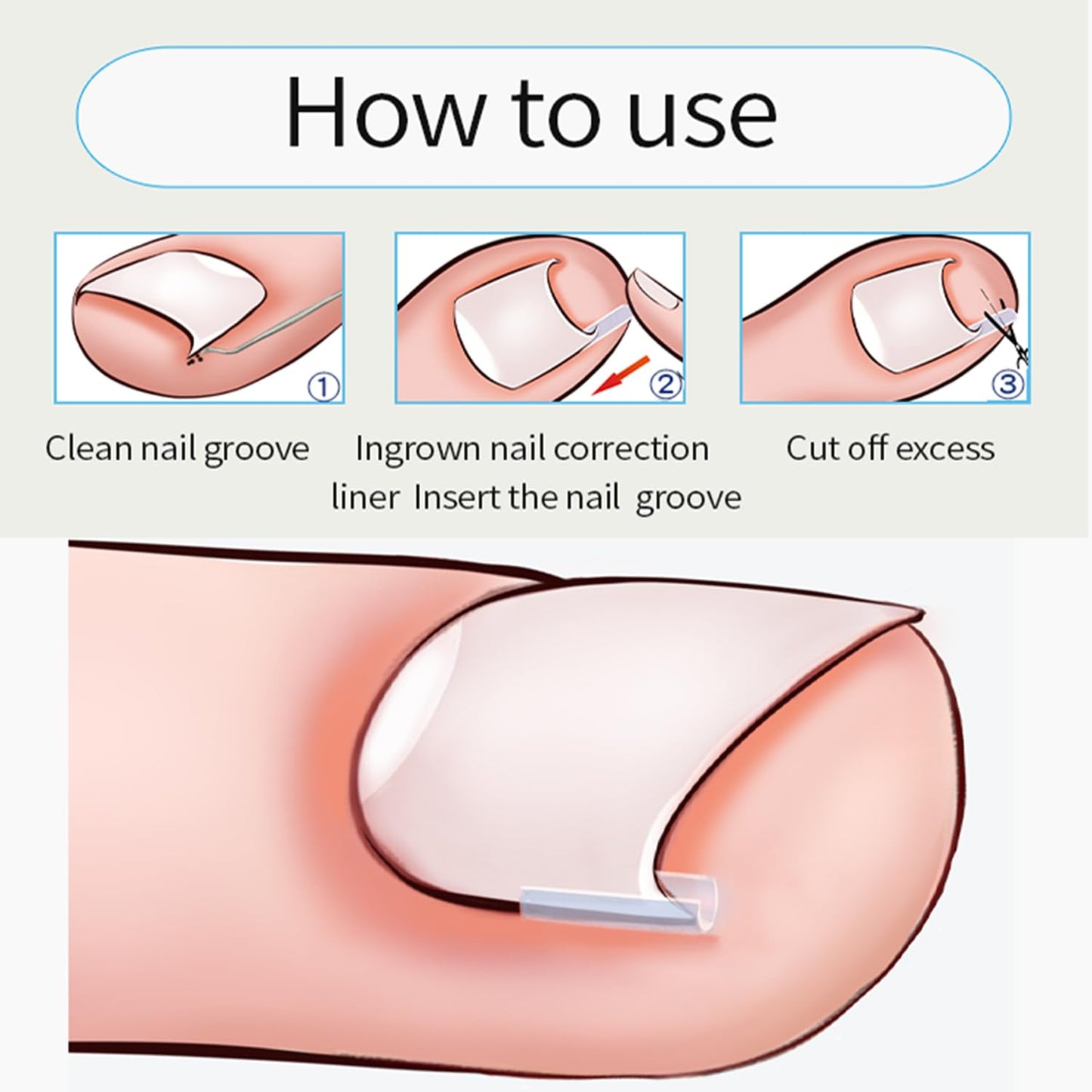 Ingrown Toenail Toolkit - Painless Curved Toenail Corrector with Breathable Strips & File | Home Pedicure Essential