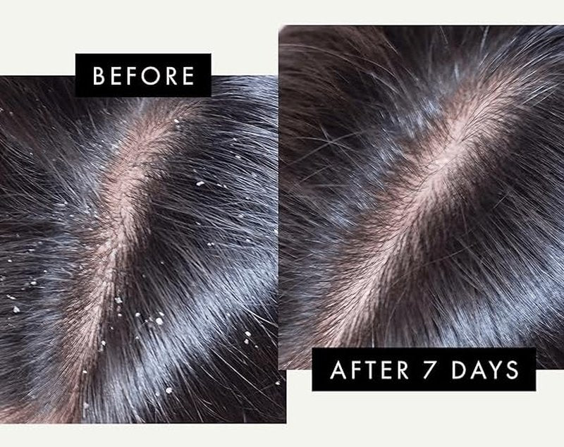 Anti-Dandruff Shampoo - Extra Strength 2% Pyrithione Zinc | Fragrance-Free, Color Safe, Sulfate Free Treatment for Flaky, Itchy Scalp