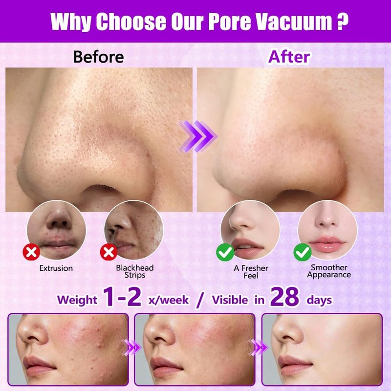 Blackhead Remover Vacuum - Pore Extractor with 3 Suction Levels & 5 Heads | Deep Cleansing Tool for Nose & T-Zone