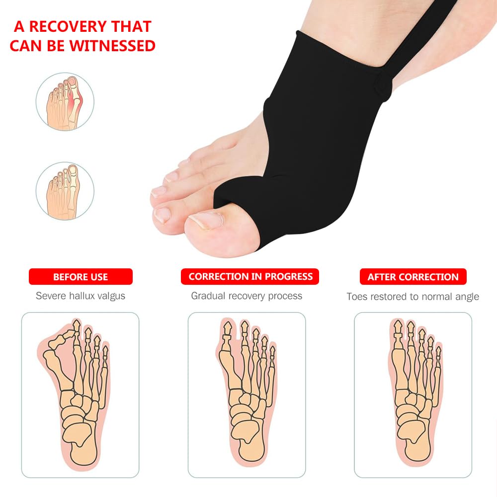 Bunion Corrector - 2PCS Big Toe Separators for Pain Relief | Comfortable & Breathable Splint for Day/Night Use