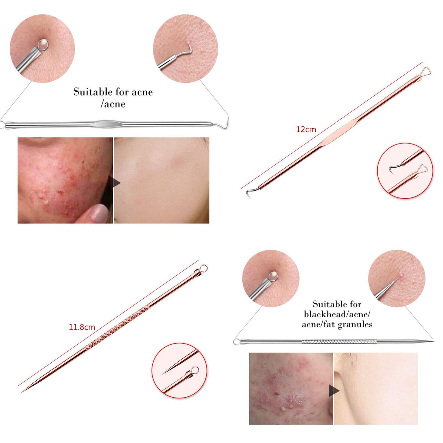 ZTRHYOO Blackhead Remover Pimple Comedone Extractor Tool Best Acne Removal Kit - Treatment for Blemish, Whitehead Popping, Zit Removing for Risk Free Nose Face Skin with Case (Rose)