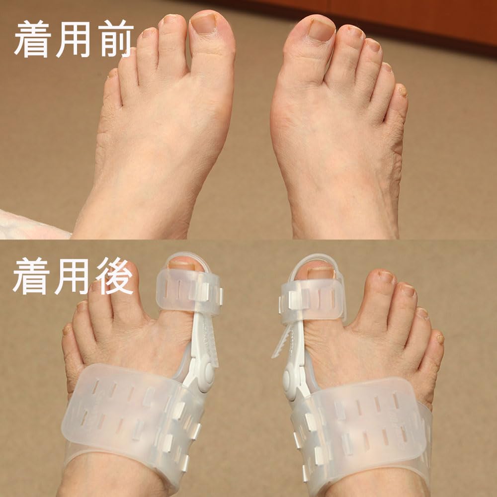 Bunion Corrector for Pain-Free Walking | Adjustable Hallux Valgus Support for Men & Women (Right Foot)