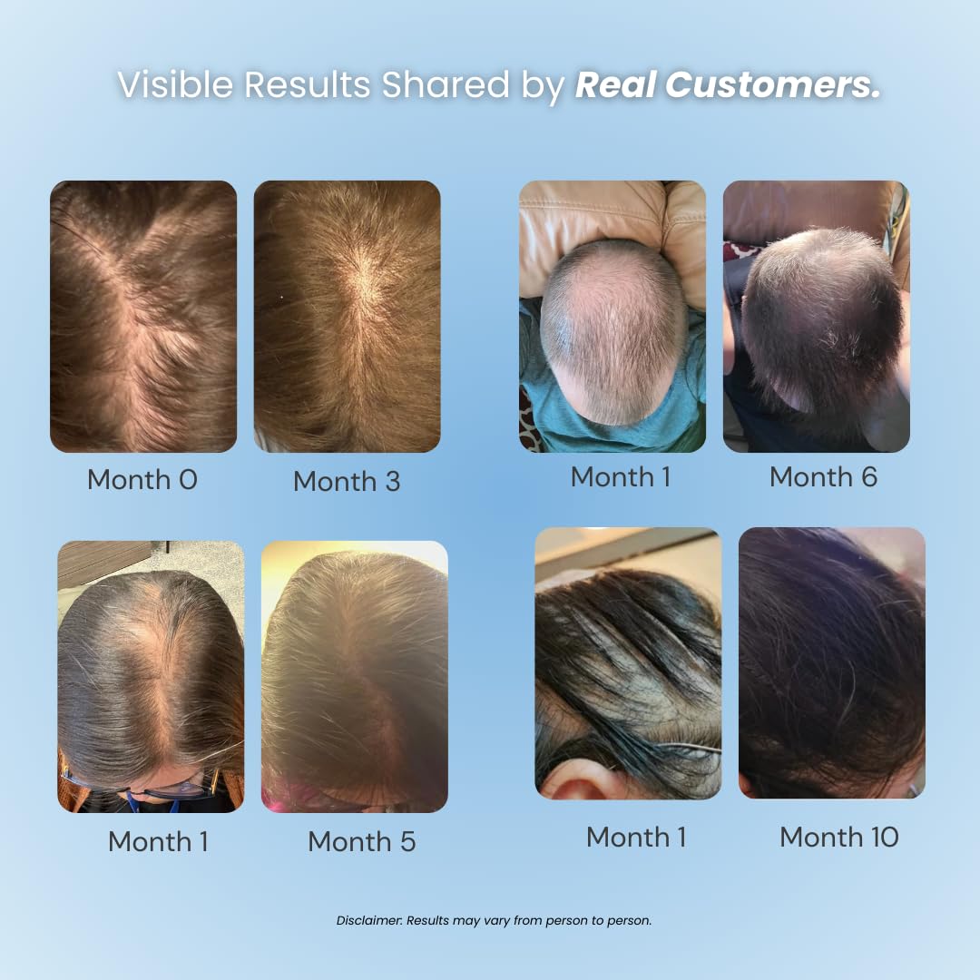 Vitafoam 5% Minoxidil Foam for Hair Regrowth | DHT Blocking, Non-Greasy, Fast-Drying Formula for Men & Women