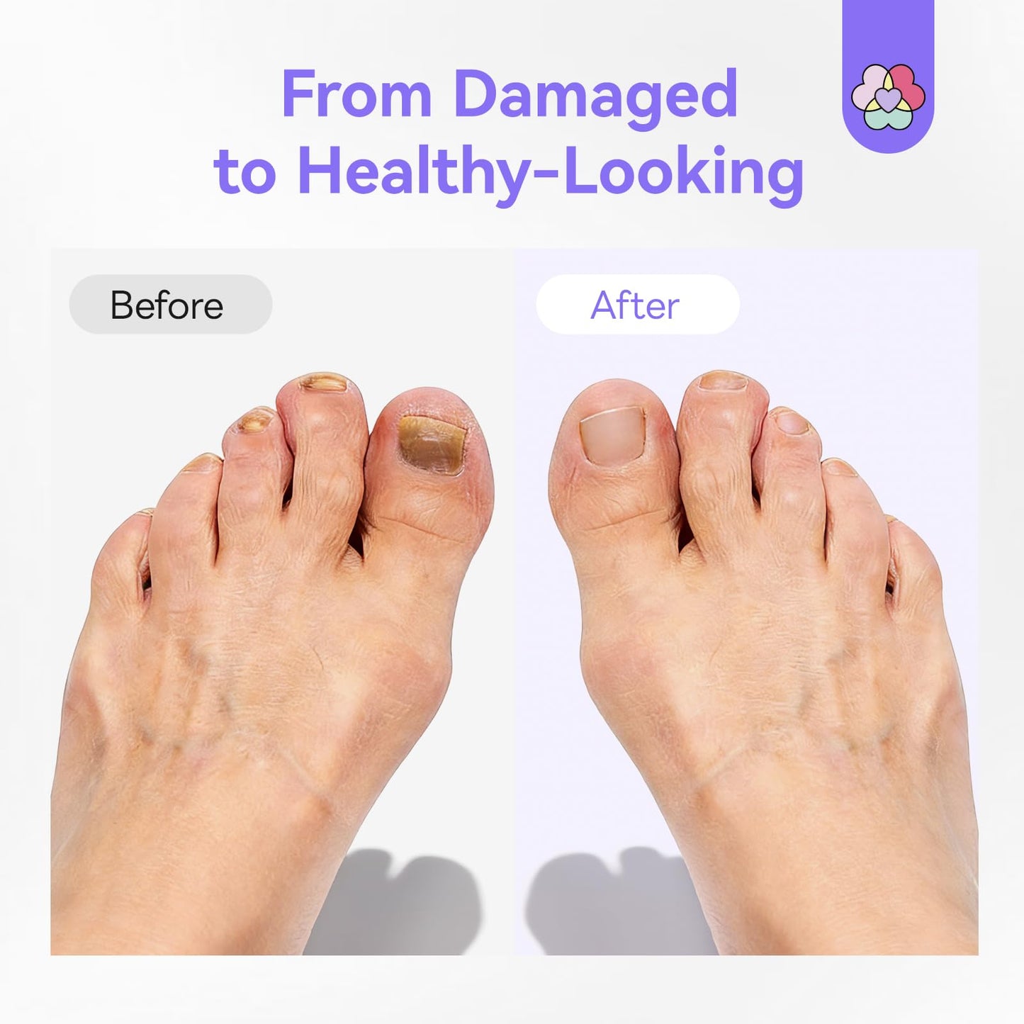 SAVILAND Toenail Fungus Pen Extra Strength FSA-HSA: Nail Fungus Pen 2X Extreme Nail Repair for Damaged Yellow Discolored Thick Foot Toe Nails Softener Treatment 25% Undecylenic Acid 1% Tolnaftate