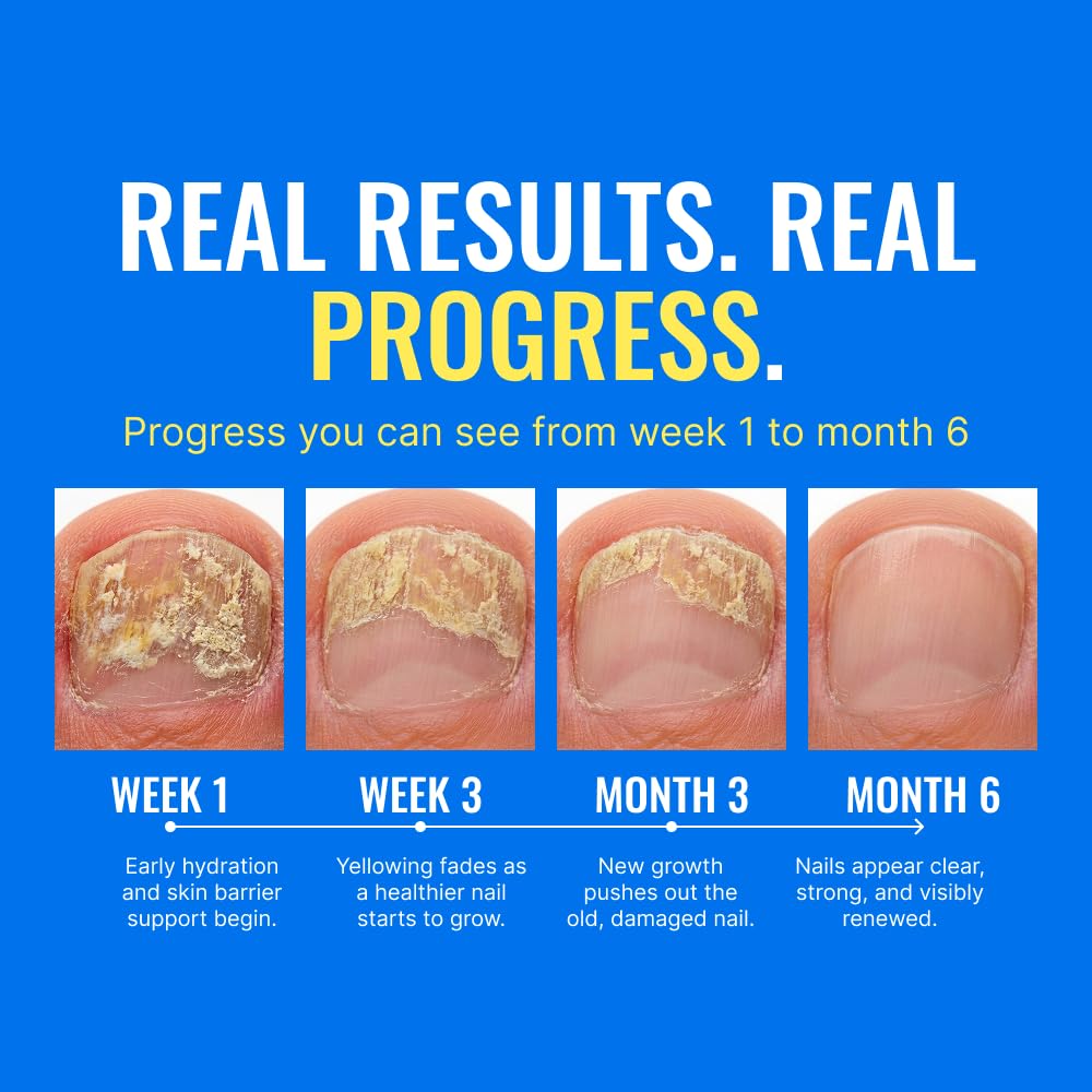 Fungix with Undecylenic Acid - Nail Solution - by Approved Science