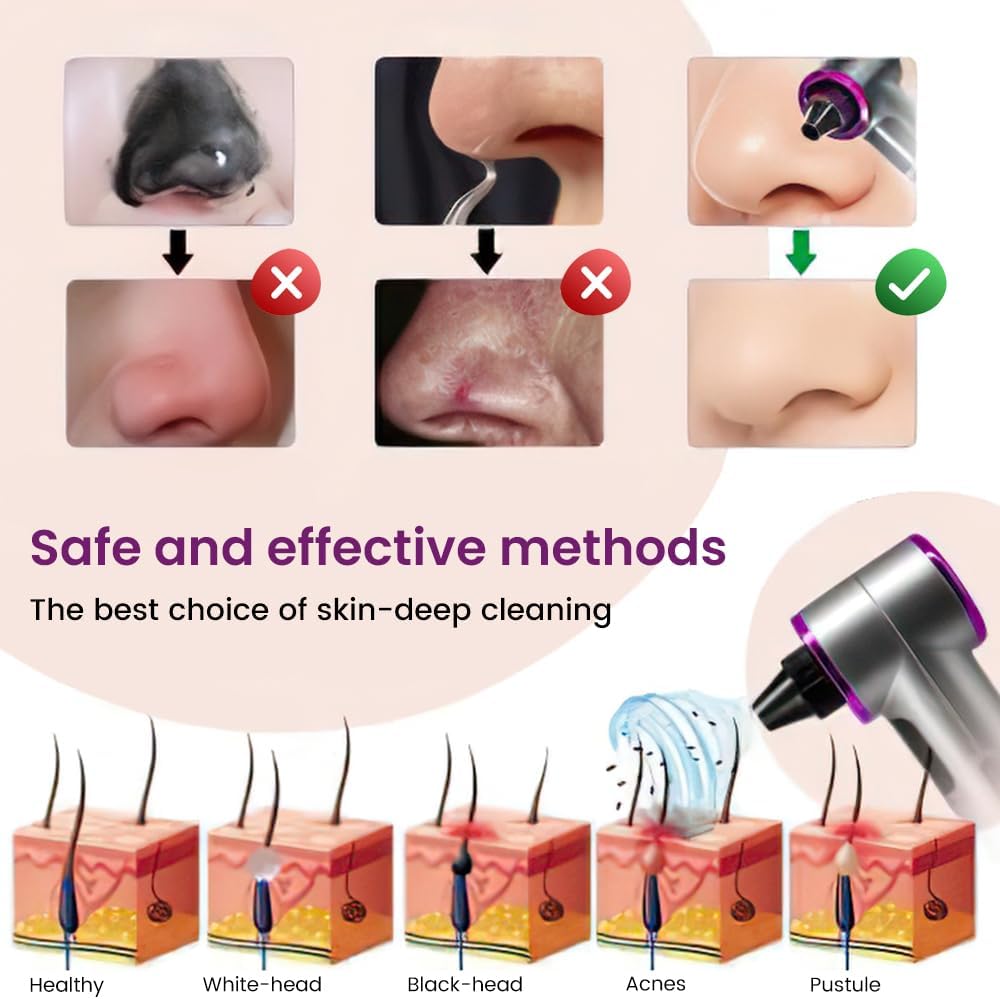 Pore Vacuum Blackhead Remover - 5 Suction Heads & 3 Levels for Deep Cleansing | Nose & Face