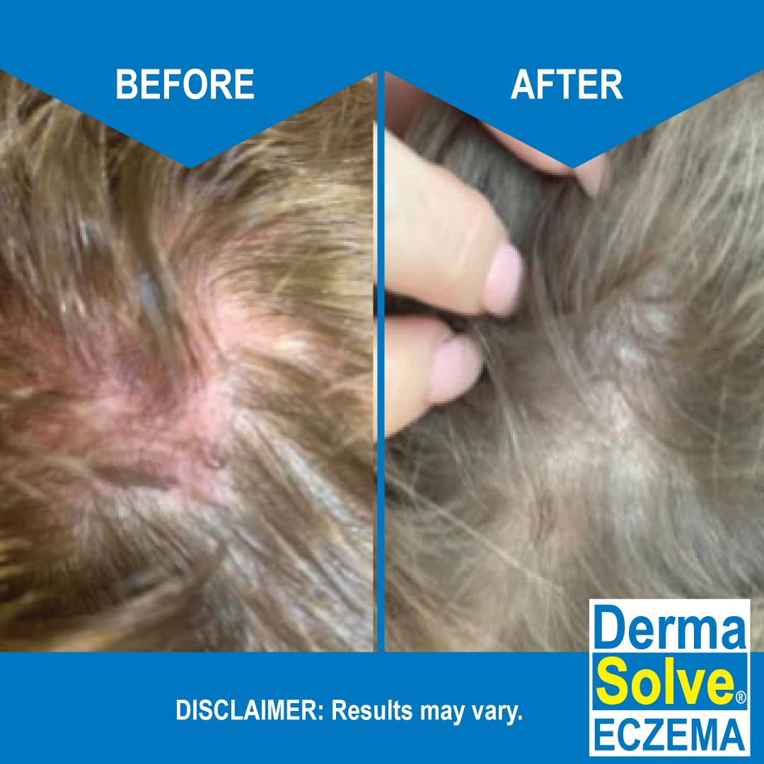 Dermasolve Eczema Relief Shampoo - Flare Control for Scalp & Dandruff | Moisturizes & Repairs Skin (2-Pack)