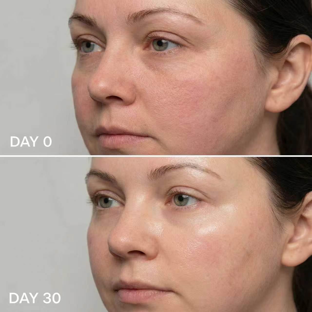 Micro Infusion System for Face & Neck | 0.25mm Facial Stamp with Collagen & Hyaluronic Acid Serum for Firmer, Smoother Skin - 1 Month Supply
