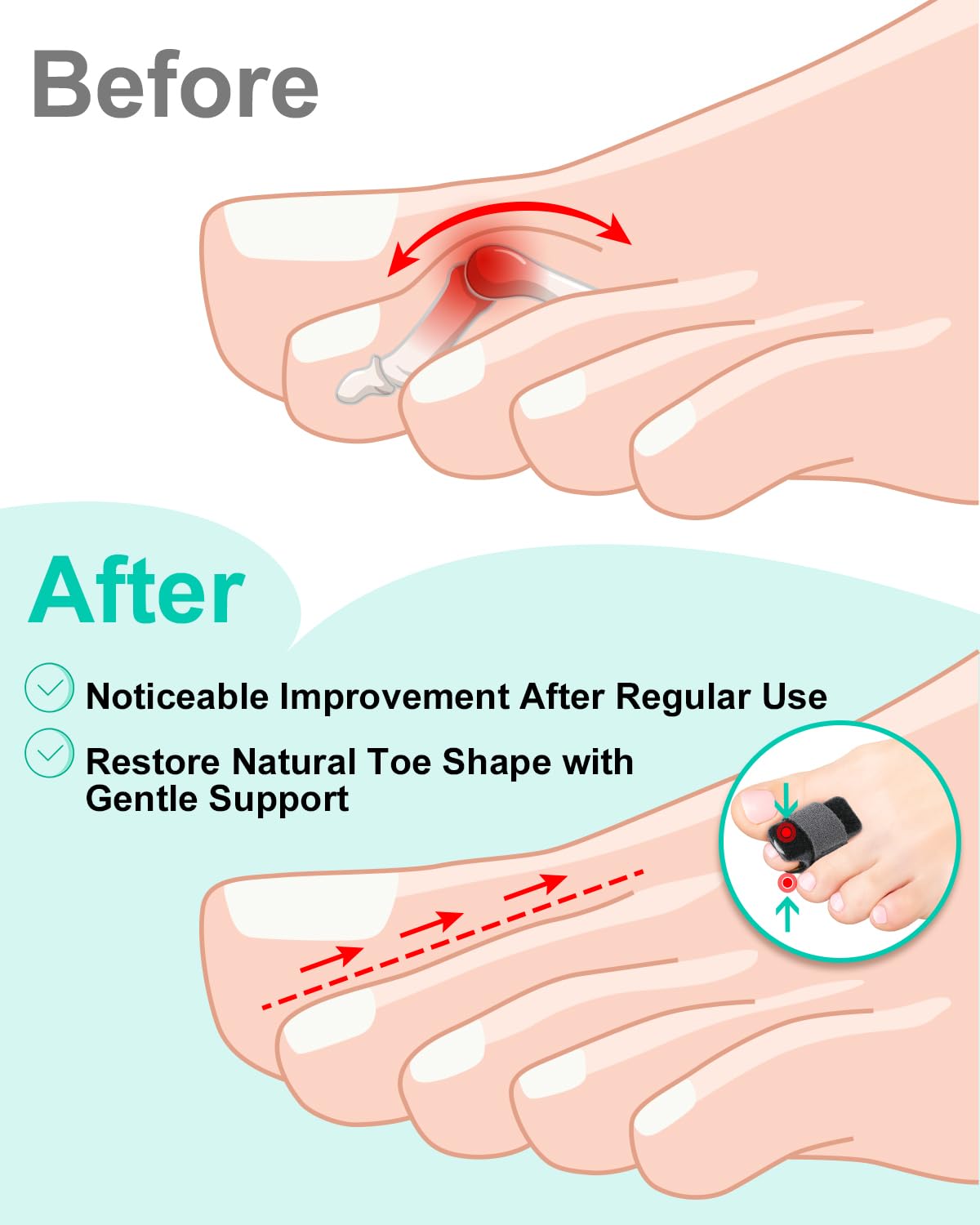 snqqmtt 2Pcs Hammer Toe Straightener with Removable Aluminum Plate and 2Pcs Broken Toe Wraps for Women & Men, Adjustable Toe Corrector for Curled & Bent Toe, Broken Support (Medium)