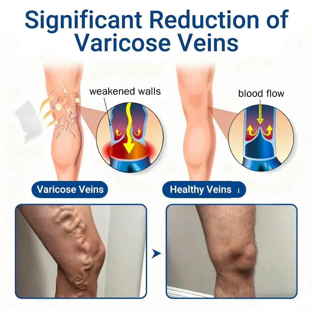 Vein Target Microdarts Patch - Effective Varicose Veins Treatment for Legs | Soothes Discomfort & Improves Circulation (1PC)