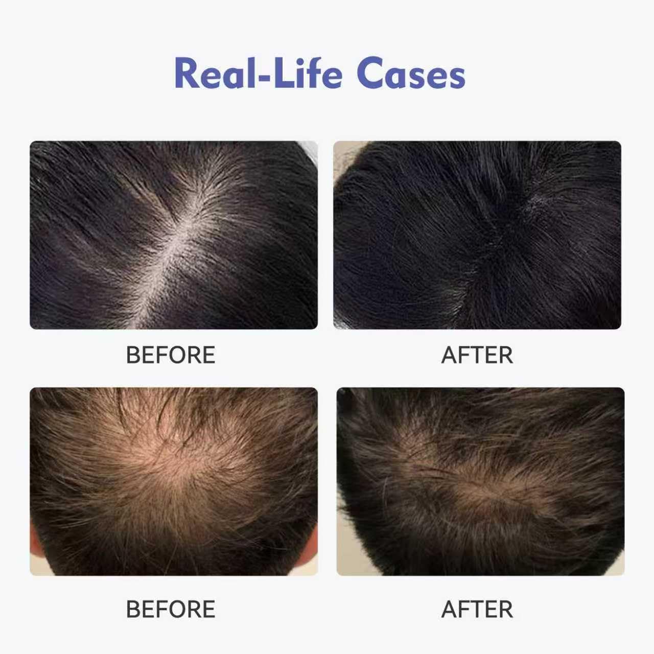 KINTOR 0.9% KX-826 DHT Blocker for Men & Women Hair Growth,Hair Growth Products Foam 60ml Pro