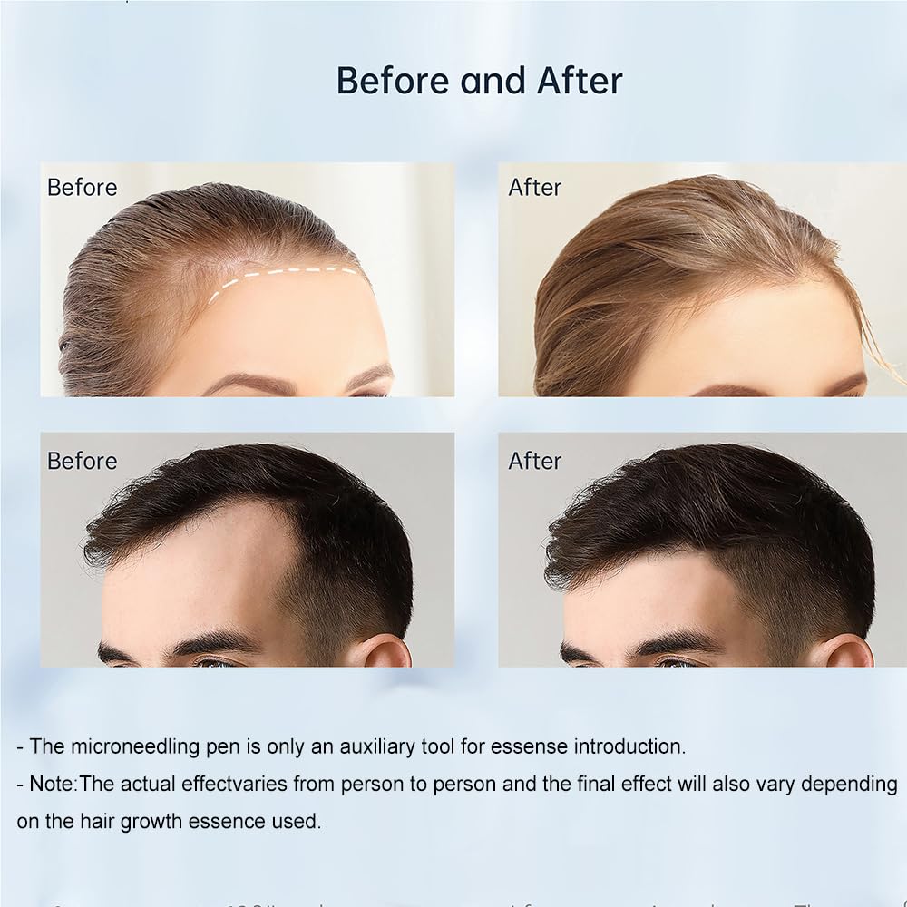 Derma Roller - 0.25mm Microneedling Beauty Tool for Home Use | Skin Care for Women & Men