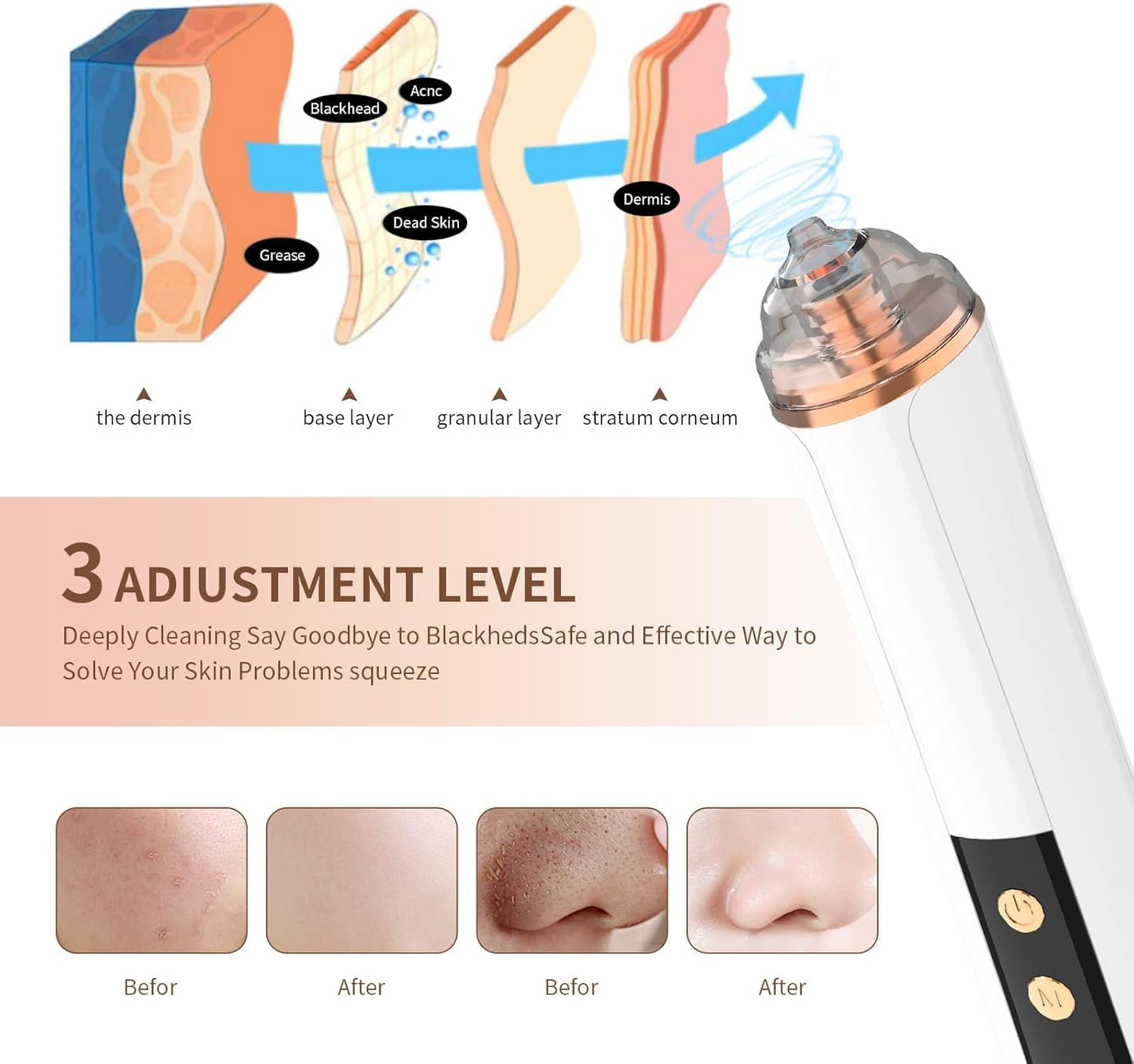 Blackhead Remover Pore Vacuum,Facial Pore Cleaner-6 Suction Power,3 Adjustable Suction Levels,USB Rechargeable Blackhead Vacuum Kit Electric Acne Extractor Tool for Women & Men