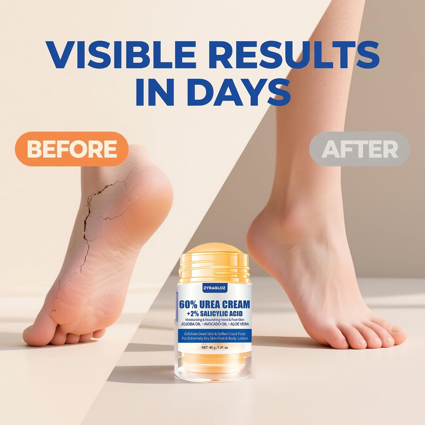ZyraGloz Urea Cream 60% plus 2% Salicylic Acid