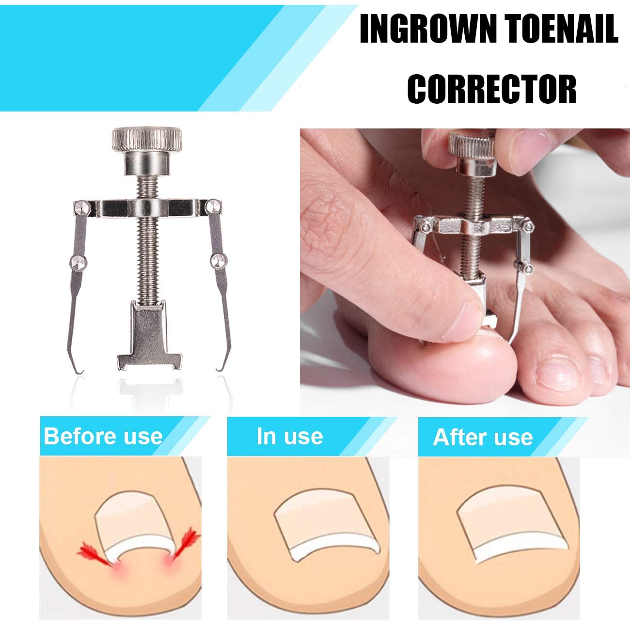 2026 Upgraded Ingrown Toenail Removal Kit, Ingrown Toenail Treatment, Stainless Steel Ingrown Toenail Corrector, Surgery Grade Ingrown Toenail Tool Tool By Dualeco