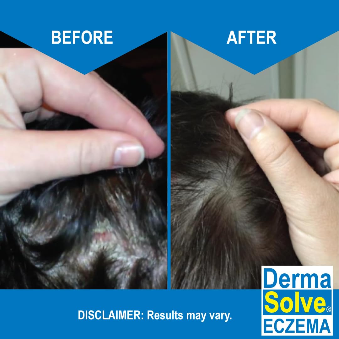 Dermasolve Eczema Relief Shampoo - Flare Control for Scalp & Dandruff | Moisturizes & Repairs Skin (2-Pack)