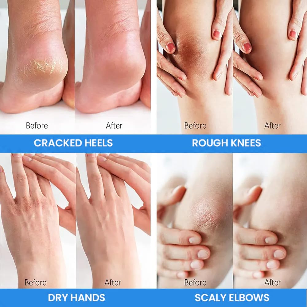 BERVEAL Urea Cream with 2% Salicylic Acid Foot Cream for Dry Cracked Heels, Heel Care Cream 5.29 Oz (Pack of 1)
