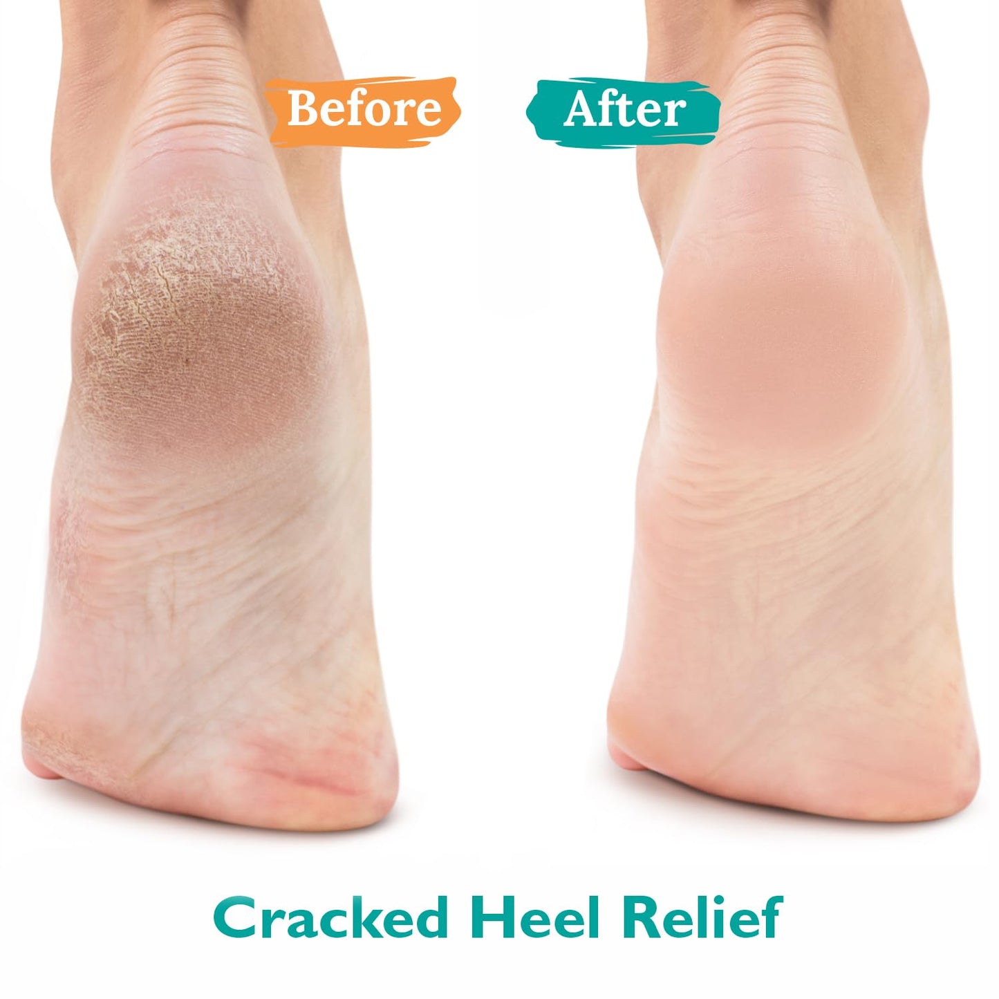 Urea Gel 42% - Maximum Strength Foot Treatment for Cracked Heels & Thick Toenails | 4 Oz