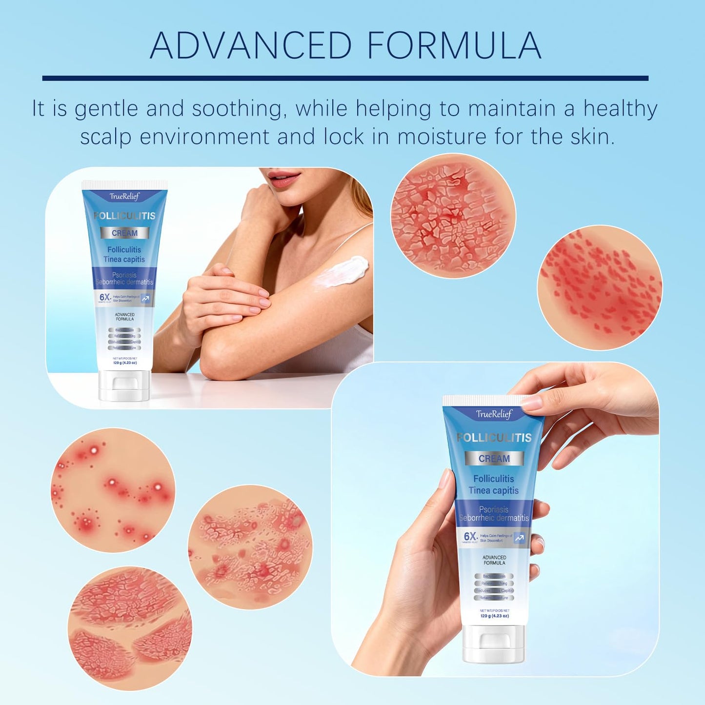 Folliculitis Cream - Soothes & Clears Bumps on Scalp, Face, Body | Ingrown Hairs & Razor Bumps Relief | 120g