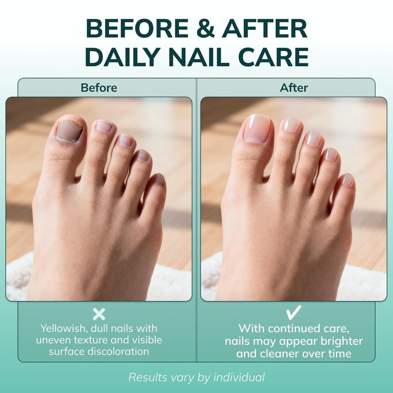 Swissklip KlearNail Toenail Stick | Medi-Care Treatment | Natural Solution for Healthy Nails I Suitable For Foot, Toe, and Fingernail I For Brittle Toenails – 10ml / 0.3 Fl. Oz. Pack 1 - Made in USA
