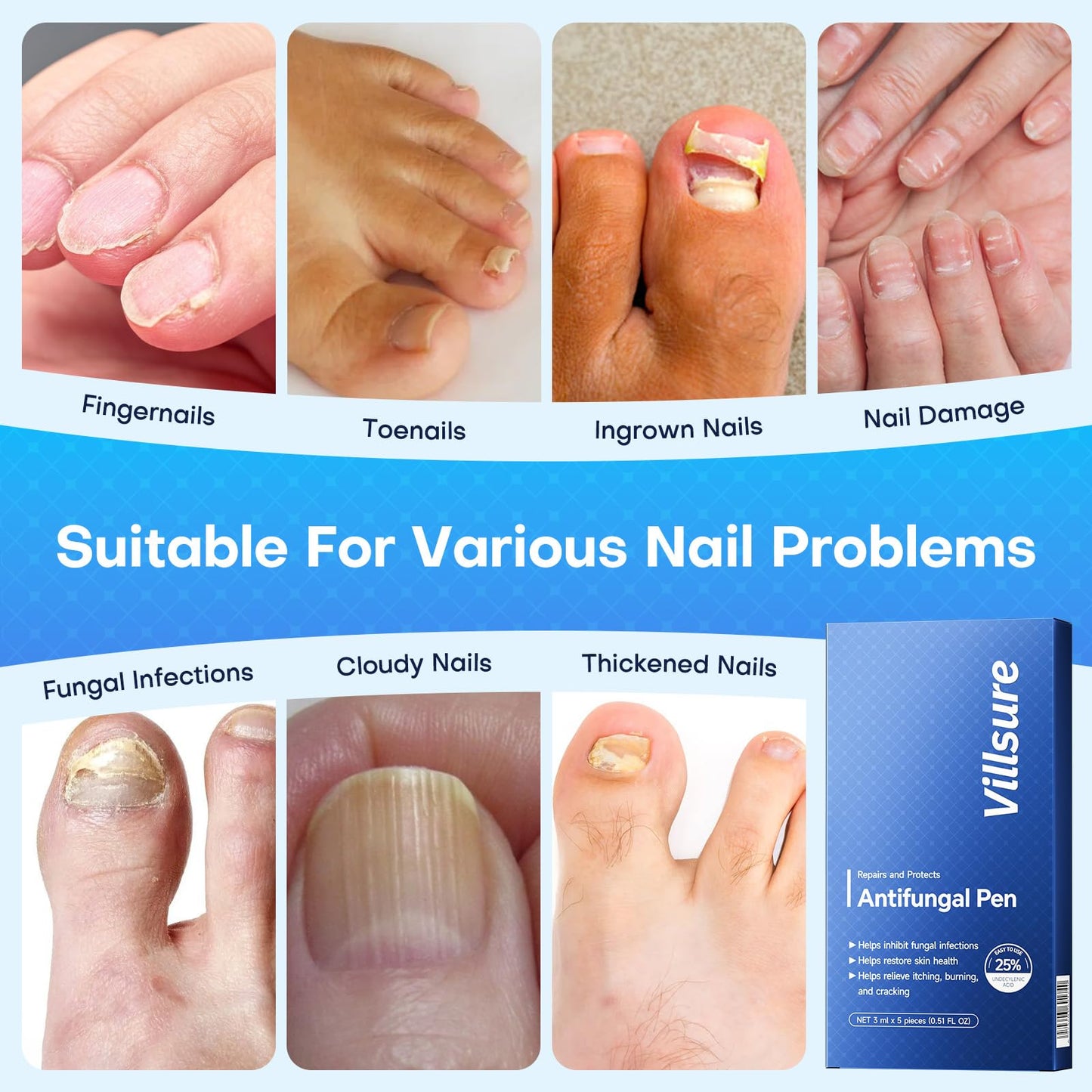 Villsure Toenail Fungus Pen - Toenail Fungus Treatment Extra Strength, Contains 25% Undecenoic Acid, Tea Tree Oils, along with Other Natural Ingredients, Mild and Non-Irritating- Nail Fungus Pen 5pcs
