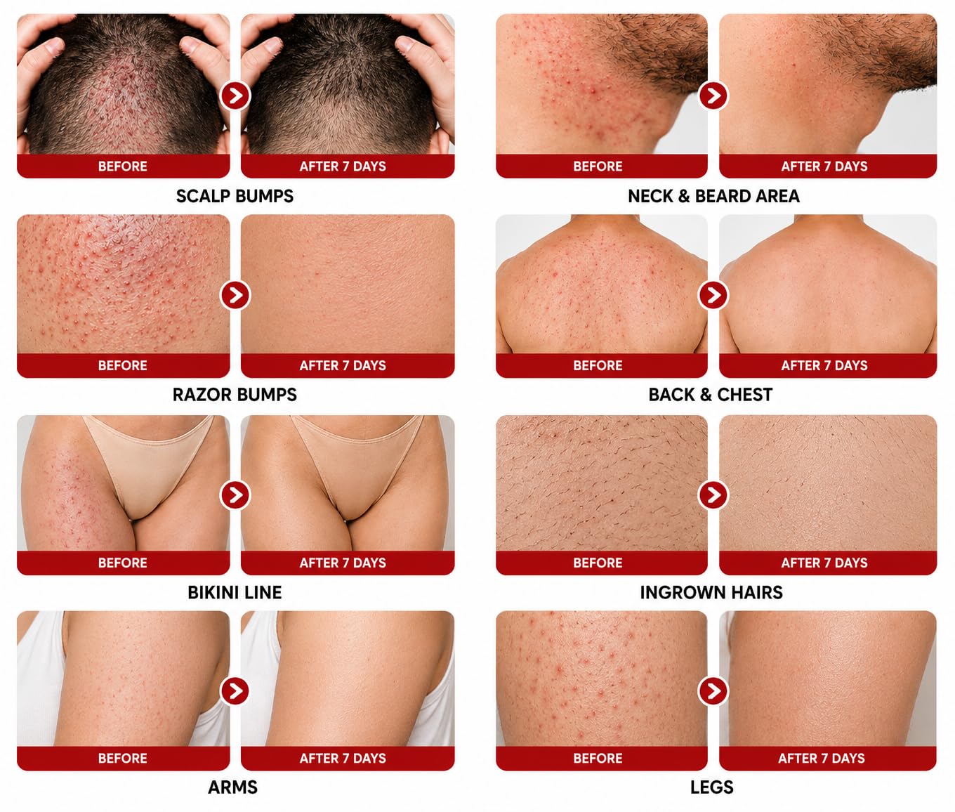 OCSINL Folliculitis Cream 5% Benzoyl Peroxide Scalp Body Care