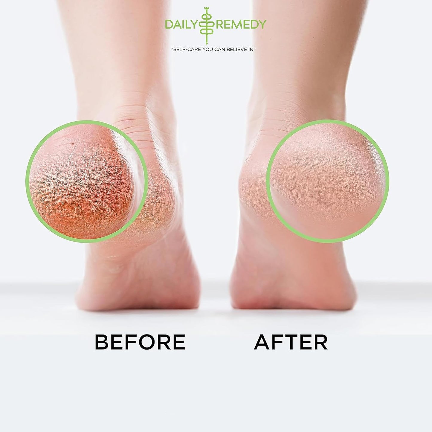 Tea Tree Oil Foot Soak | Epsom Salt Relief for Toenail Irritations, Athlete's Foot & Odor - 16 Ounce