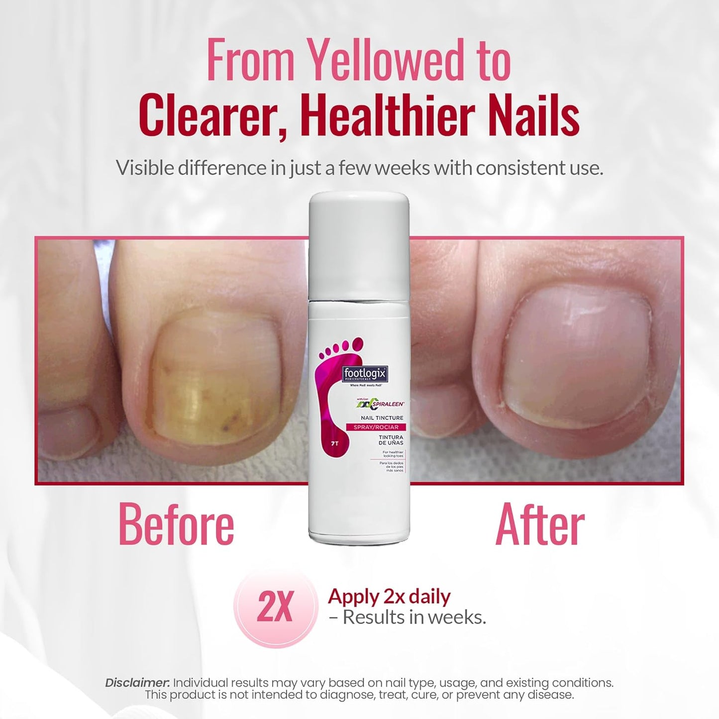 FOOTLOGIX Nail Tincture Spray - Spiraleen Formula for Healthy Nails | 1.55 Fl Oz