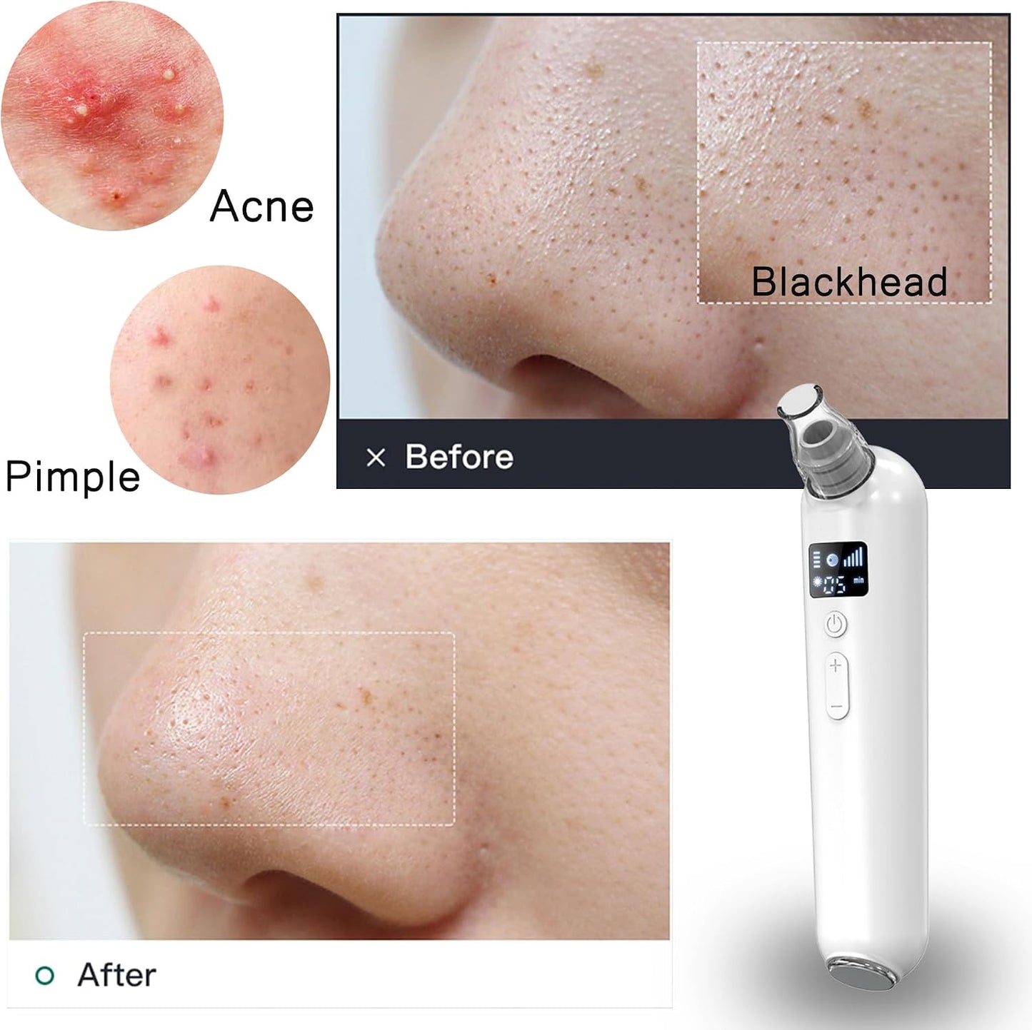 Blackhead Remover Vacuum - Rechargeable Pore Cleaner with Heat & Red Light | 5 Suction Levels, 6 Probes, LED Display