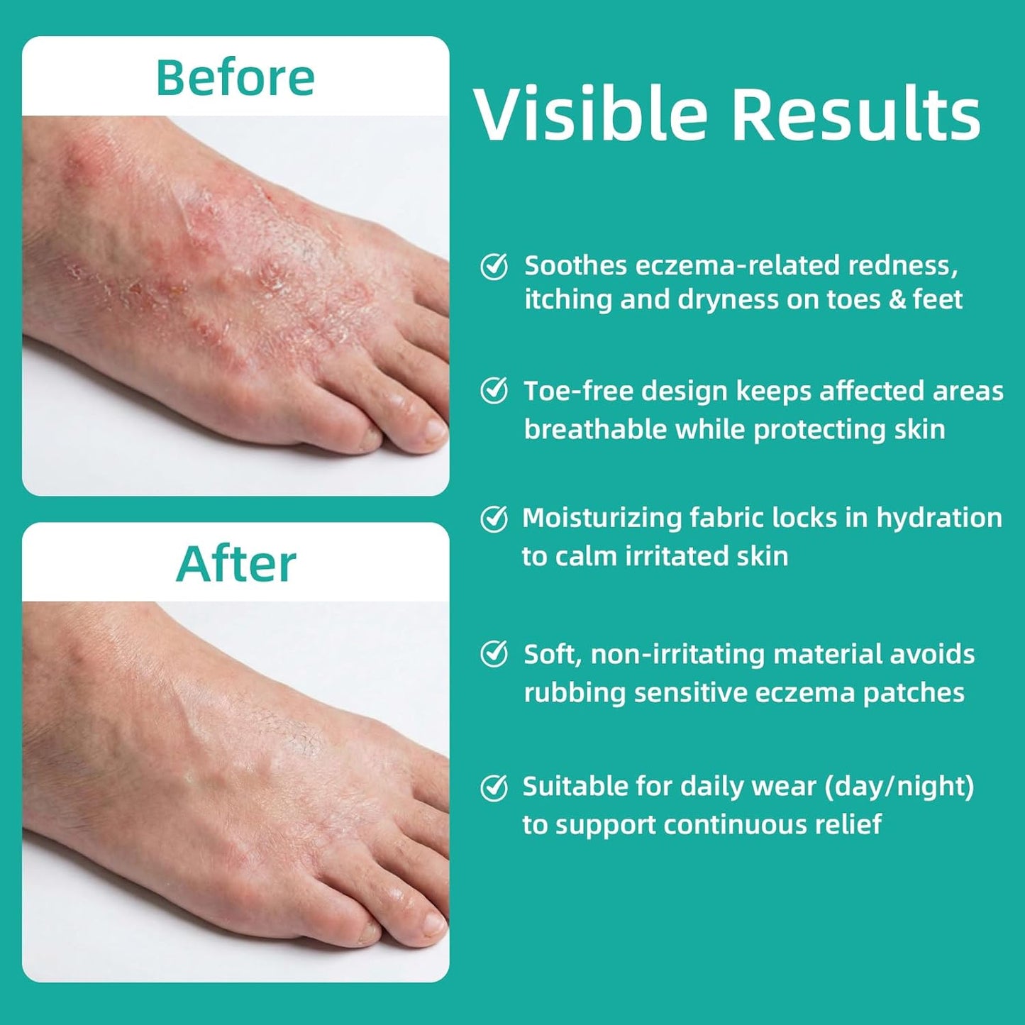 Cotton Eczema Toeless Socks - Moisturizing Open Toe Heel Socks for Soft Feet | XL, White