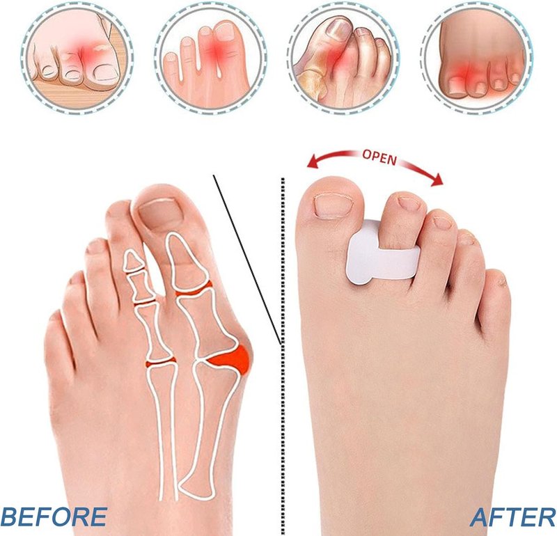 Gel Toe Separators - 10 Pcs for Overlapping Toes & Bunions | Big Toe Alignment Corrector (Blue)