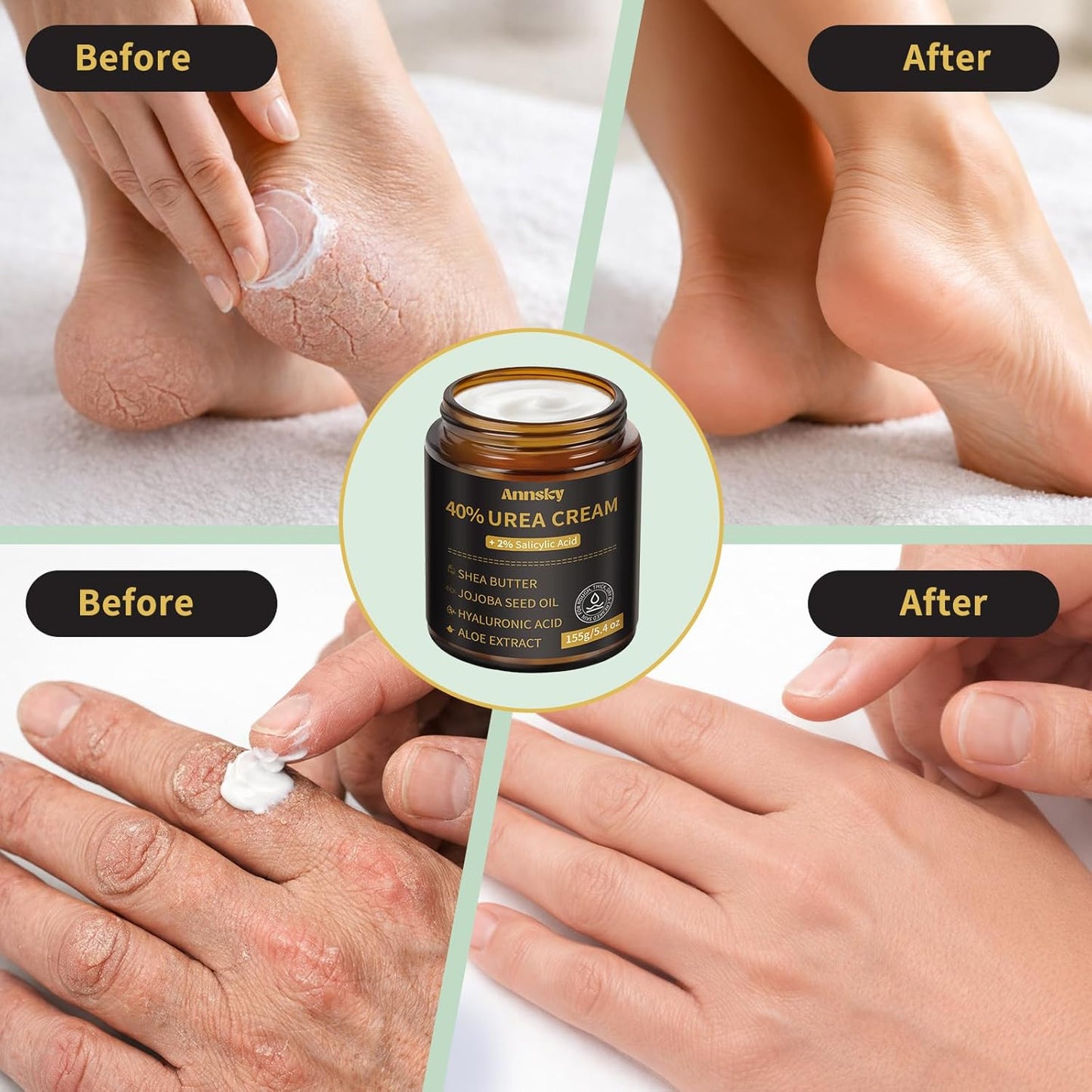 Urea Cream 40% with Salicylic Acid 2% - Maximum Strength Foot Cream for Dry, Cracked Heels | 155g