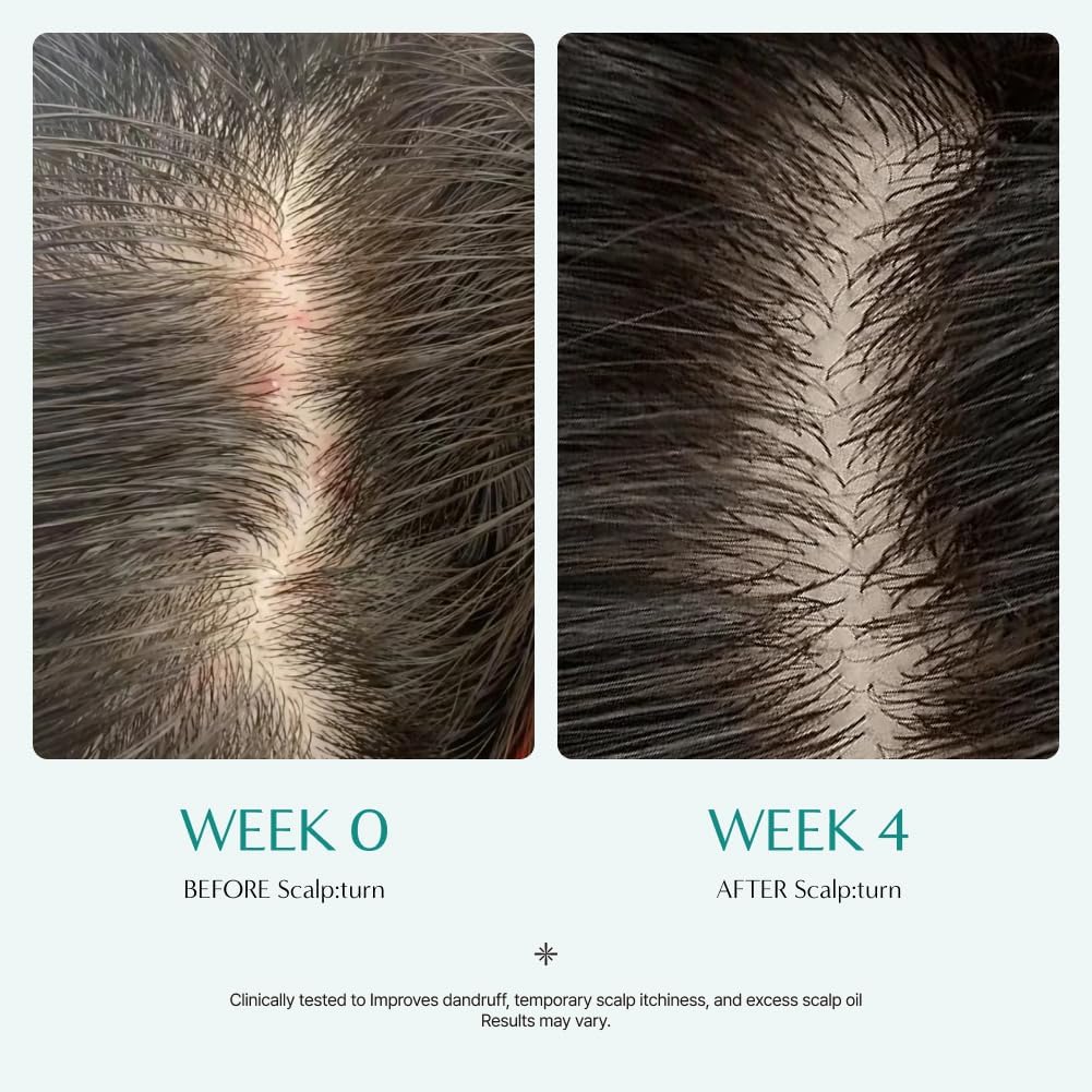 Lilyeve ScalpTurn Cica PDRN Scalp Serum - Strengthen Hair Roots & Relieve Itchy Scalp | 3.38 fl. oz