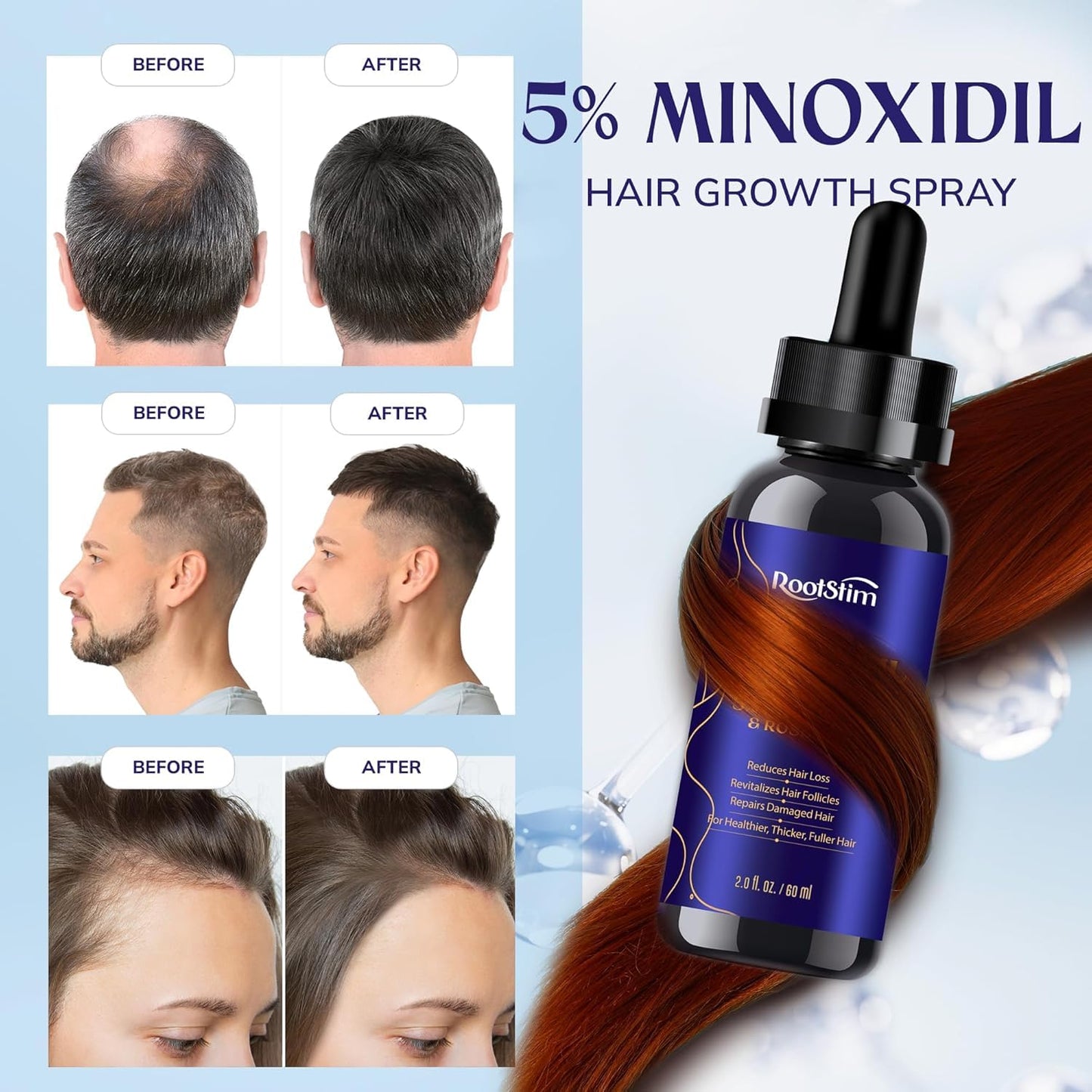 Minoxidil Hair Growth Kit for Women - Extra Strength 5% with Rosemary & Biotin | 2 Fl Oz for Thinning Hair Regrowth