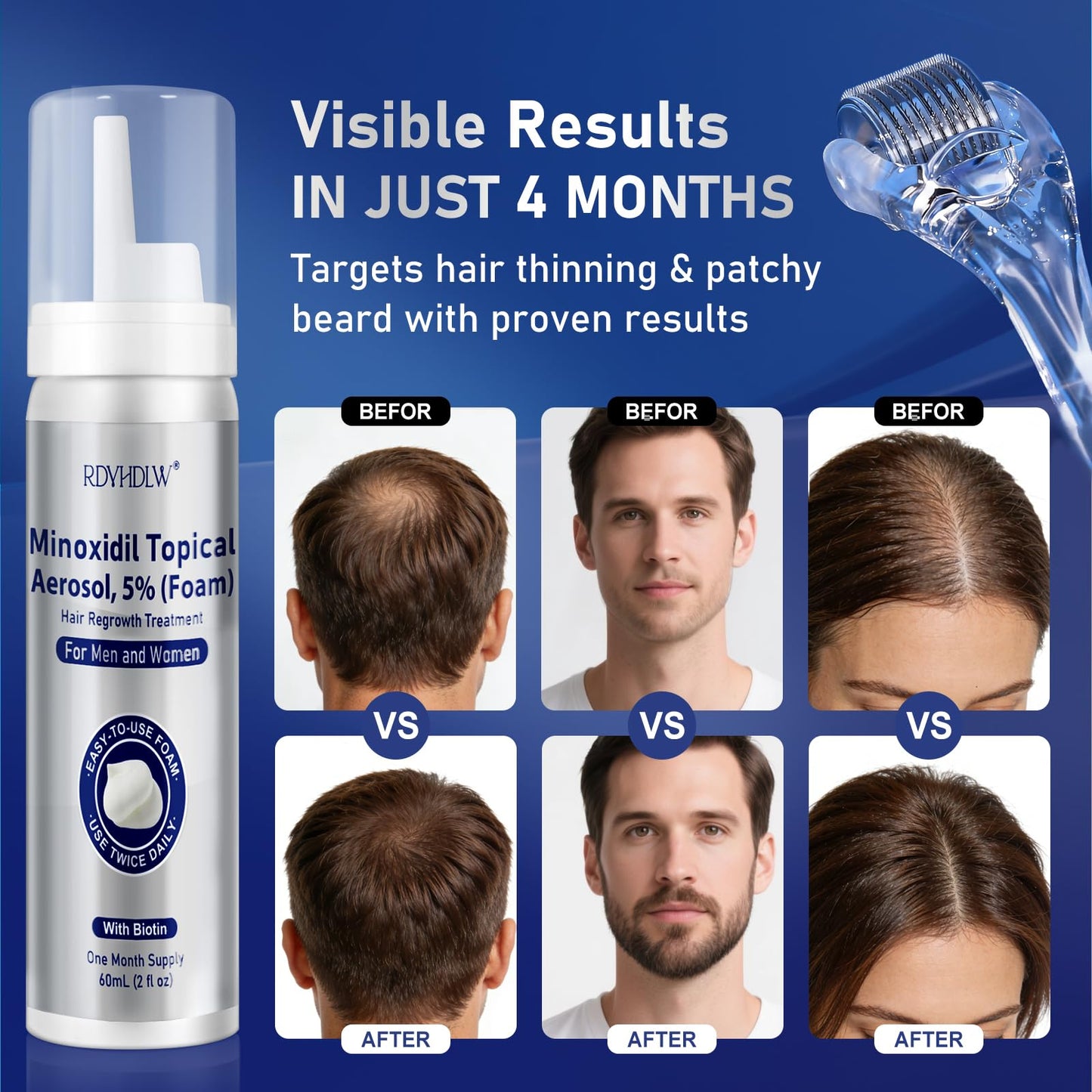5% Minoxidil Foam for Men and Women Hair Growth, Minoxidil for Men Foam for Hair and Beard, Hair Regrowth Treatment Helps Regrow Hair Loss & Thinning (7pcs, 14.77oz, 7 Month Supply)