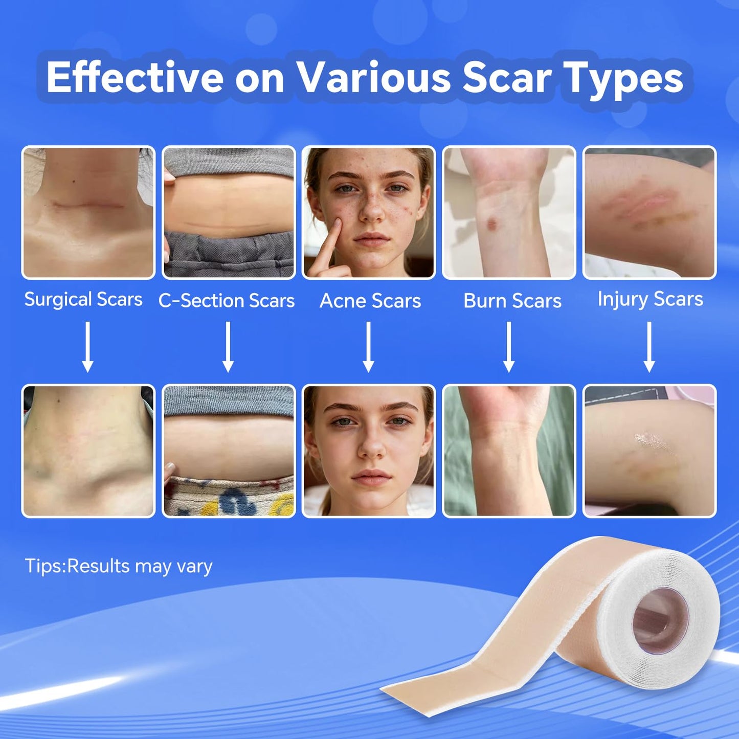 Silicone Scar Sheets - Professional Reusable Scar Tape & Patch for Effective Scar Treatment | 1.5M Length