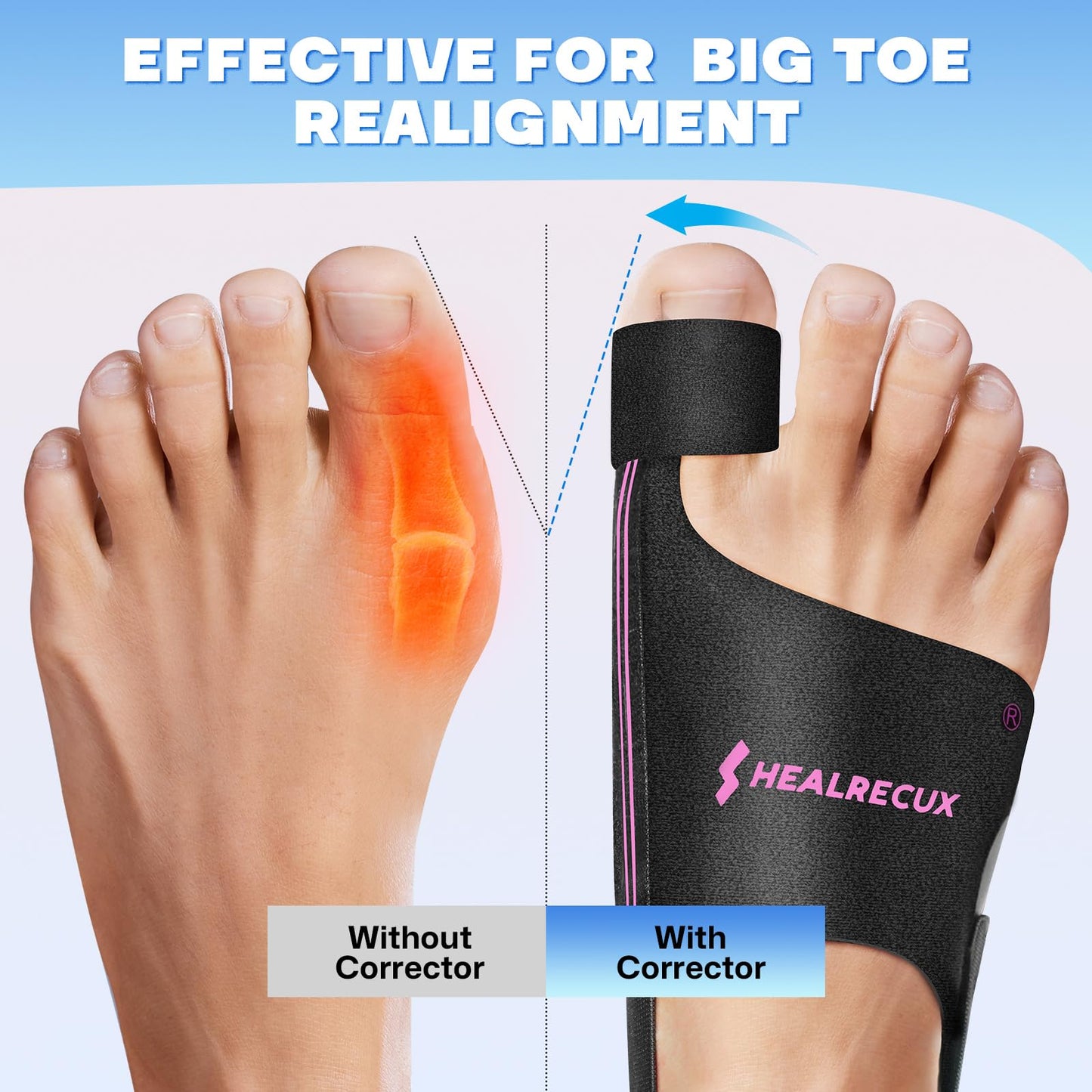Healrecux Bunion Corrector & Hammer Toe Splint - with Flexible Steel Springs & Cushion Pad, Hallux Valgus Corrector for Strong Alignment & Pain Relief, Bunion Brace for Women Men - Pink Stripes