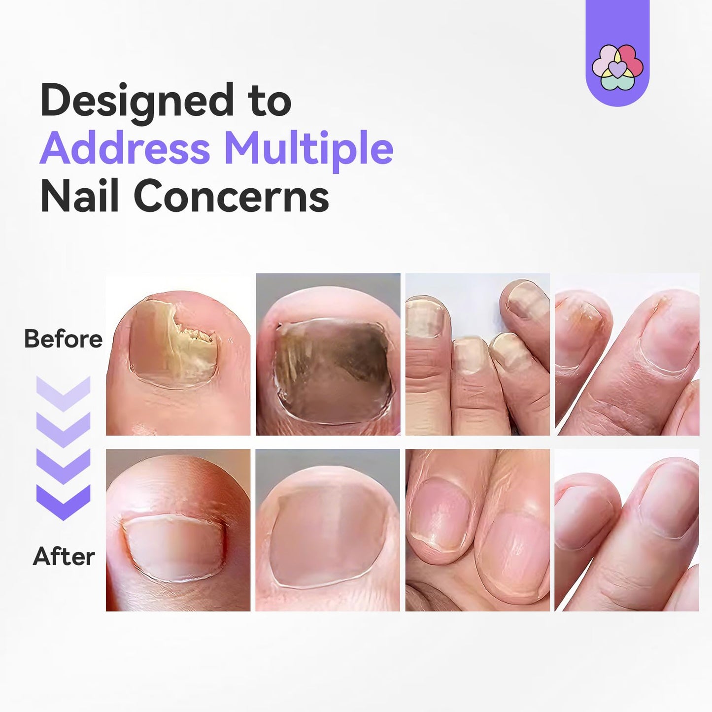 SAVILAND Toenail Fungus Pen Extra Strength: FSA-HSA 25% Undecylenic Acid 1% Tolnaftate Nail Fungus Pen 2X Nail Repair for YellowDamaged Discolored Thick Foot Toe Nails Softener Treatment Solution