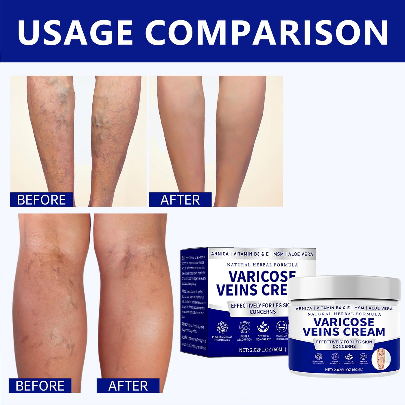 Varicose Veins Cream - Natural Herbal Formula for Effective Spider Vein Treatment | Skin Care for Women & Men