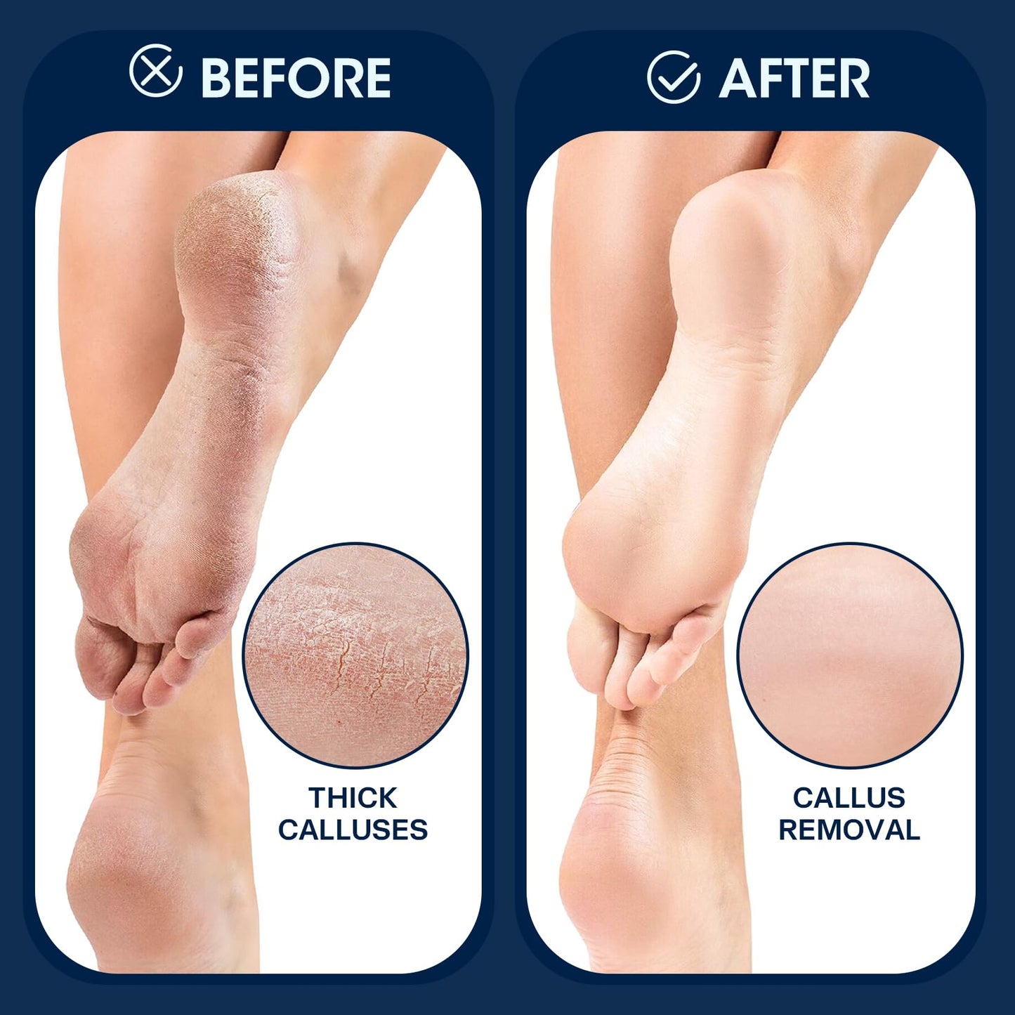 Shmian Electric Callus Remover for Feet, Rechargeable Foot File Pedicure Kit – Cordless Dead Skin Remover for Cracked Heels, Hard & Dry Skin, Waterproof Foot Care Tool for Home Use & Travel